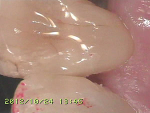 名古屋市西区の伊藤歯科医院のムシ歯治療の症例